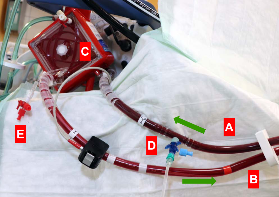 ECMO Aufbau